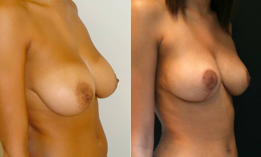 Réduction mammaire à Paris 17 par Dr Pachet, spécialiste en chirurgie réparatrice