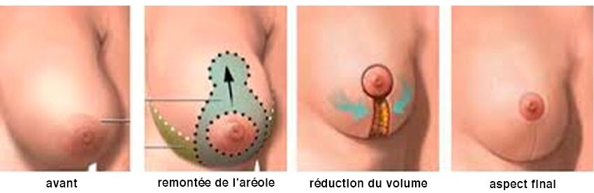 La réducation mammaire en Schéma par Dr Pachet Paris 17