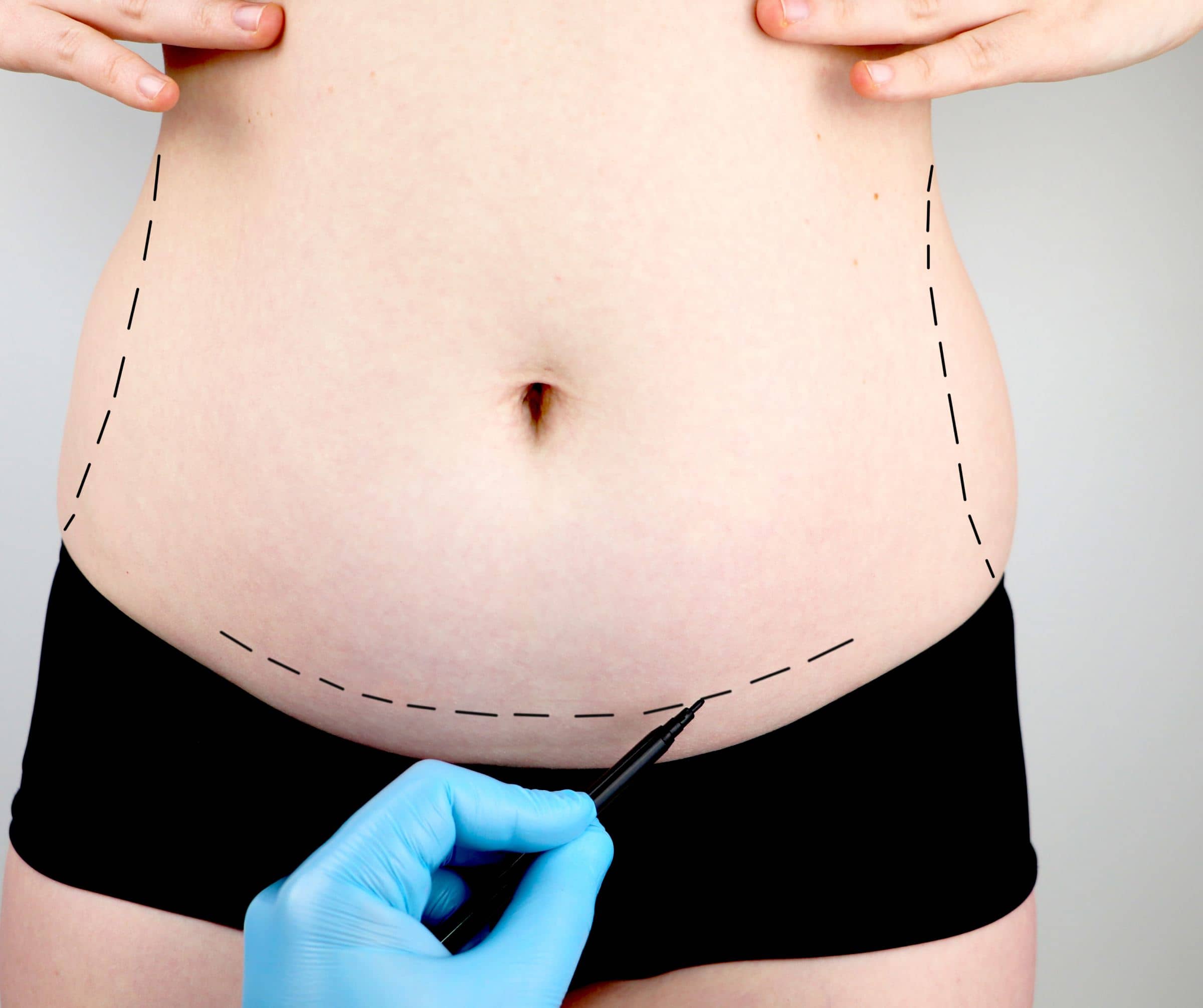Au bout de combien de temps les résultats d'une plastie abdominale sont-ils visibles ? | Dr Corinne Pachet | Paris