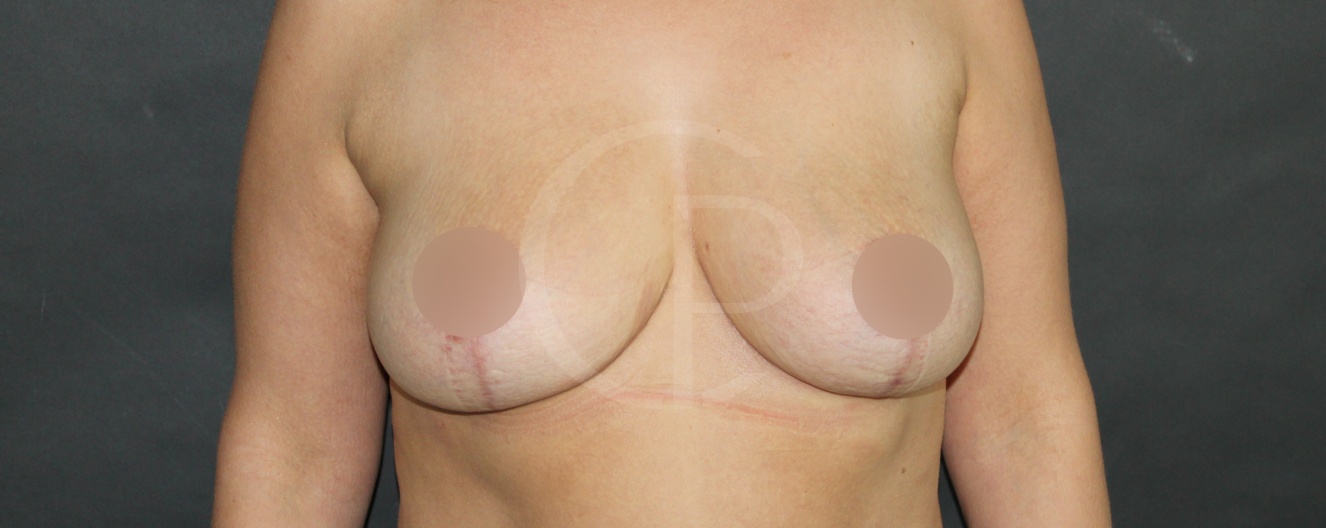 Photo après réduction mammaire | Dr Pachet | Paris