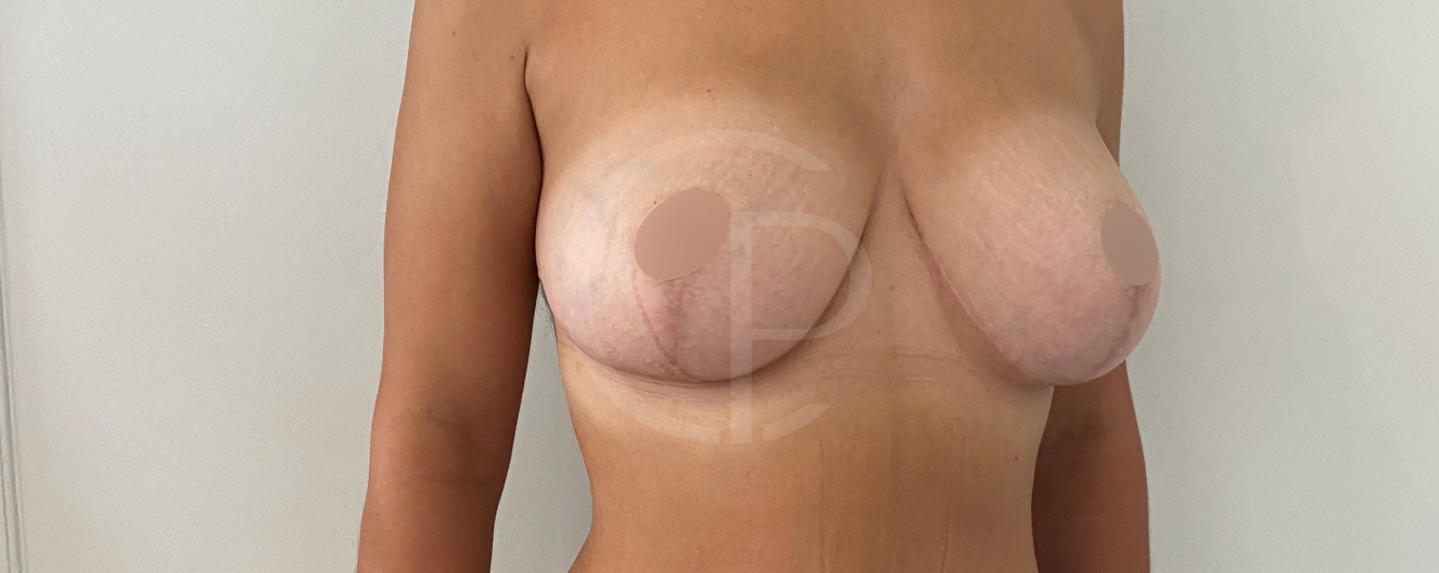 Avant et après la chirurgie de reduction mammaire | Dr Pachet | Clinique Paris