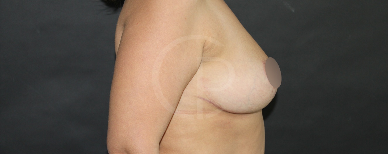 Photo avant et après d'une réduction mammaire | Dr Pachet | Paris 17