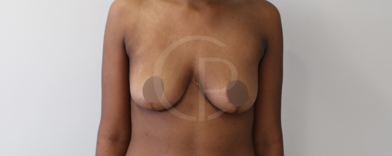 Résultat apres une chirurgie de la réduction mammaire | Dr Pachet | Paris 17