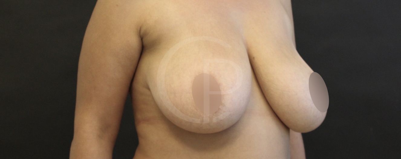 Reduction mammaire | Dr Pachet | Paris 17