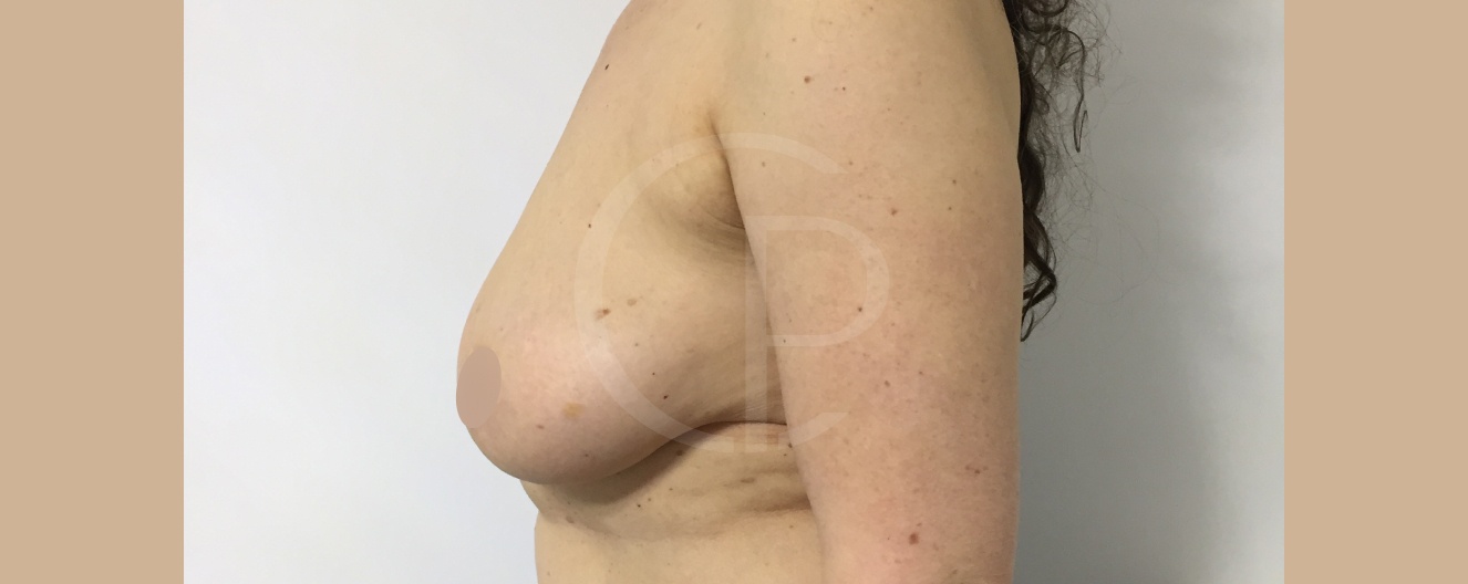 Suivi post-opératoire | Réduction mammaire | Dr Pachet