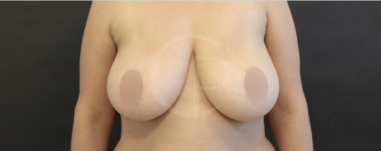Photo avant réduction mammaire | Dr Pachet | Paris