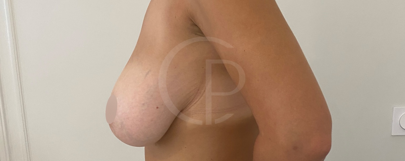 Avant/après chirurgie mammaire | Dr Pachet | Paris 17