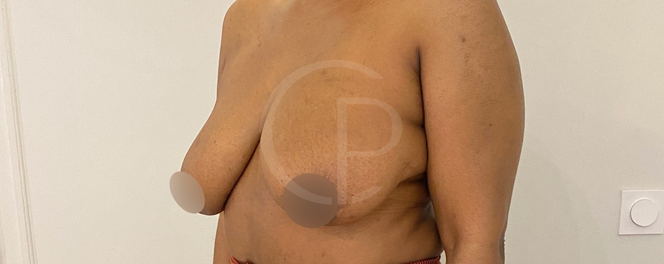 Avant la réduction mammaire | Dr Pachet | Paris 17