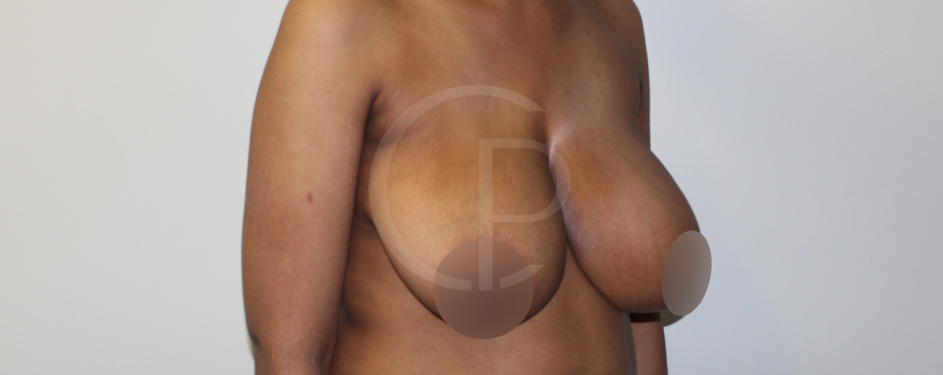 Avant et après d'une réduction mammaire | Dr Pachet | Paris 17
