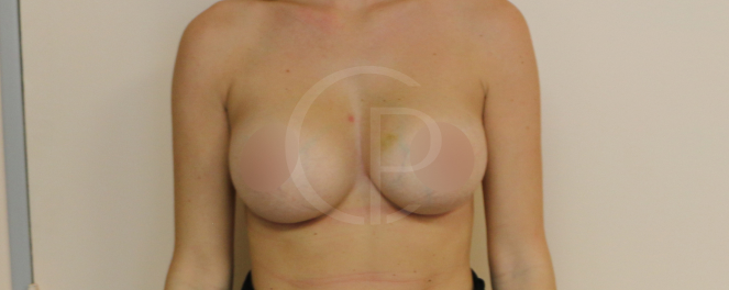 Photo avant et après d'une augmentation mammaire | Dr Pachet | Paris