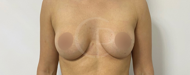 Avant et après photo d'une augmentation mammaire| Dr Pachet | Paris