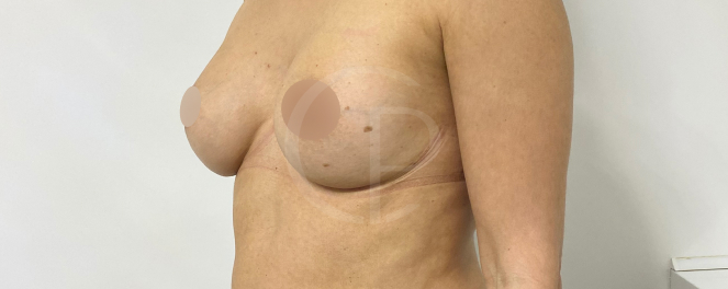 Photo avant et après montrant une transformation esthétique notable des seins | Dr Pachet | Paris