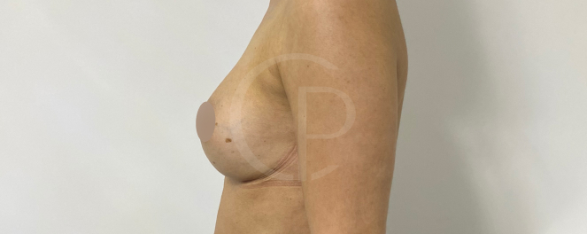 Image montrant une amélioration de la poitrine grâce à l'augmentation mammaire | Dr Pachet | Paris