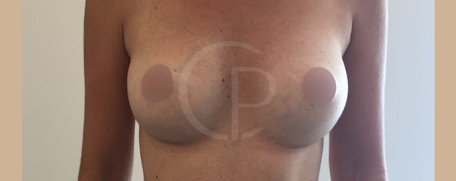 Photo illustrant une amélioration de la posture suite à une augmentation mammaire | Dr Pachet | Paris
