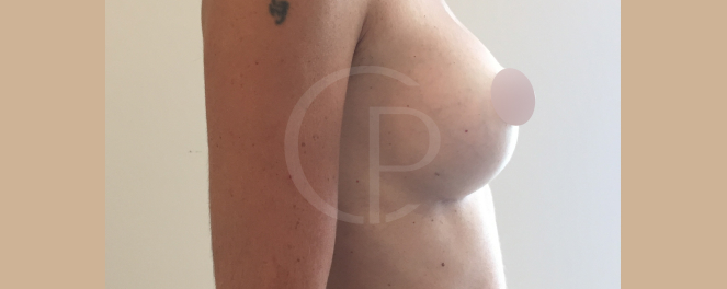 Image avant et après une augmentation mammaire | Dr Pachet | Paris