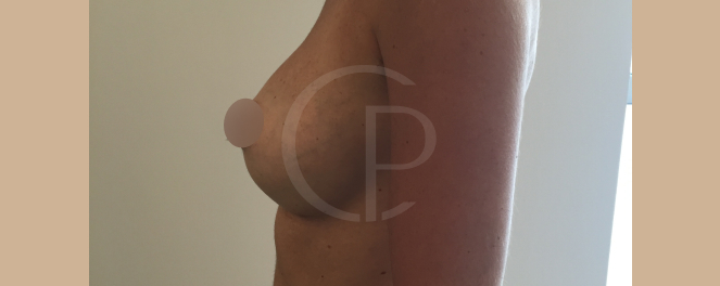 Image illustrant un profil corporel plus équilibré suite à une augmentation mammaire | Dr Pachet | Paris