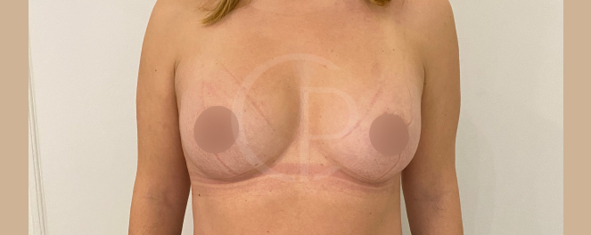 Photo montrant une silhouette plus féminine et élégante suite à l'augmentation mammaire | Dr Pachet | Paris