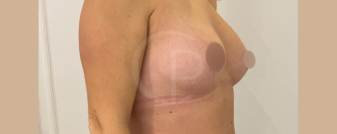 Photo comparant les seins avant et après l'opération, avec une meilleure proportionnalité | Dr Pachet | Paris