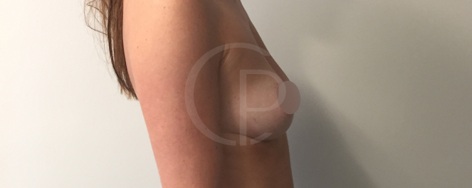 Image avant et après chirurgie montrant une amélioration de la symétrie des seins | Dr Pachet | Paris