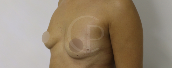 Photo avant et après montrant une transformation esthétique notable des seins | Dr Pachet | Paris