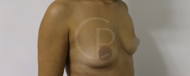 Photo illustrant un changement de forme des seins suite à la chirurgie | Dr Pachet | Paris