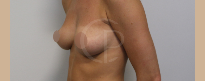 Photo comparant les seins avant et après chirurgie | Dr Pachet | Paris