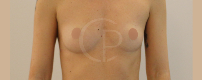 Photo illustrant une amélioration de la posture suite à une augmentation mammaire | Dr Pachet | Paris