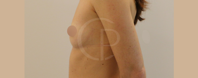 Image illustrant un profil corporel plus équilibré suite à une augmentation mammaire | Dr Pachet | Paris