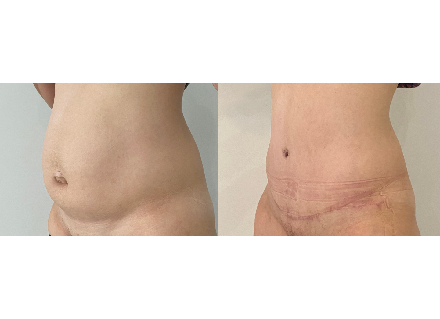 PLASTIE ABDOMINALE POST GRAVIDIQUE AVEC RÉPARATION DE LA PAROI MUSCULAIRE ABDOMINALE