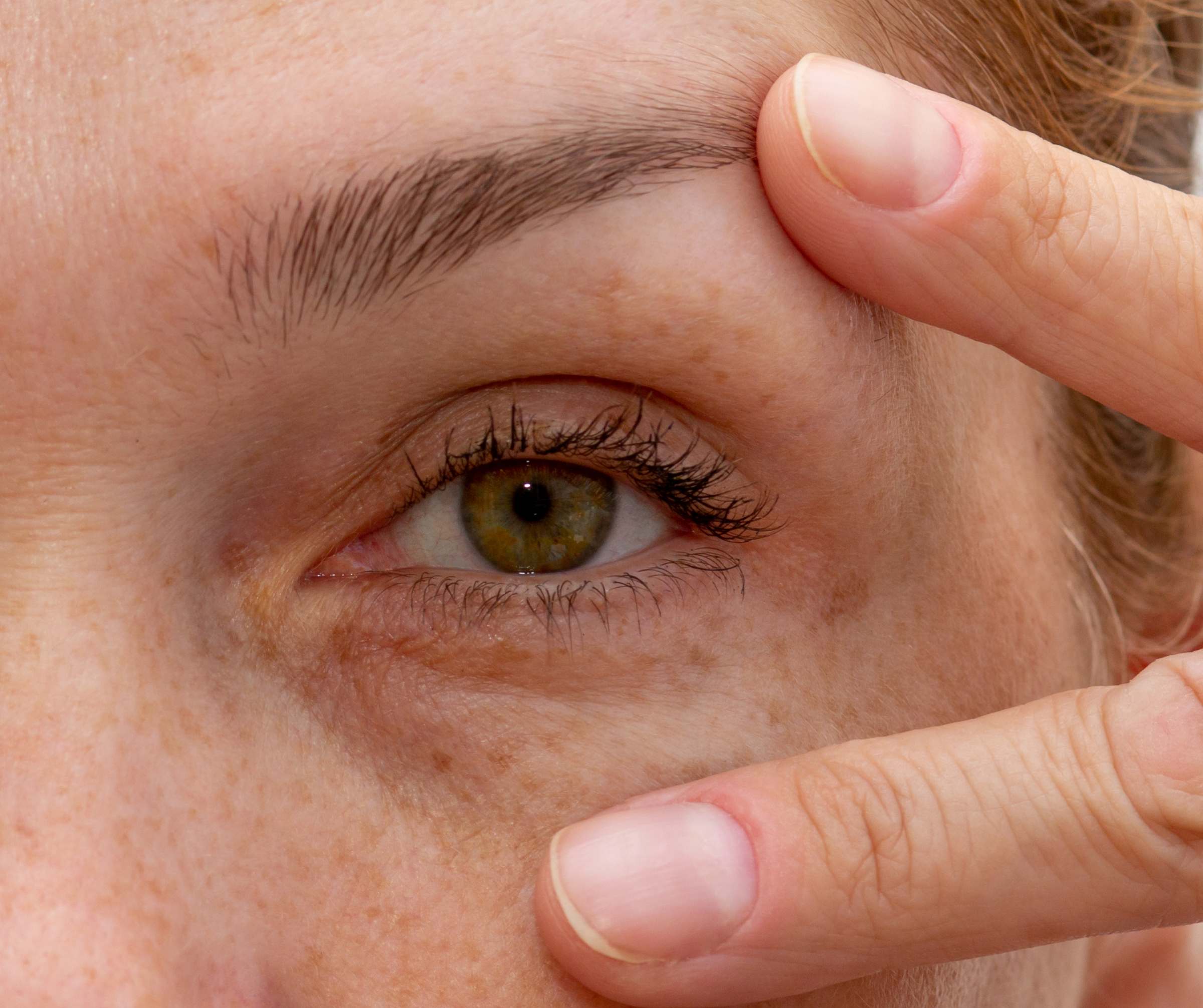 Blépharoplastie inférieure ou supérieure ?