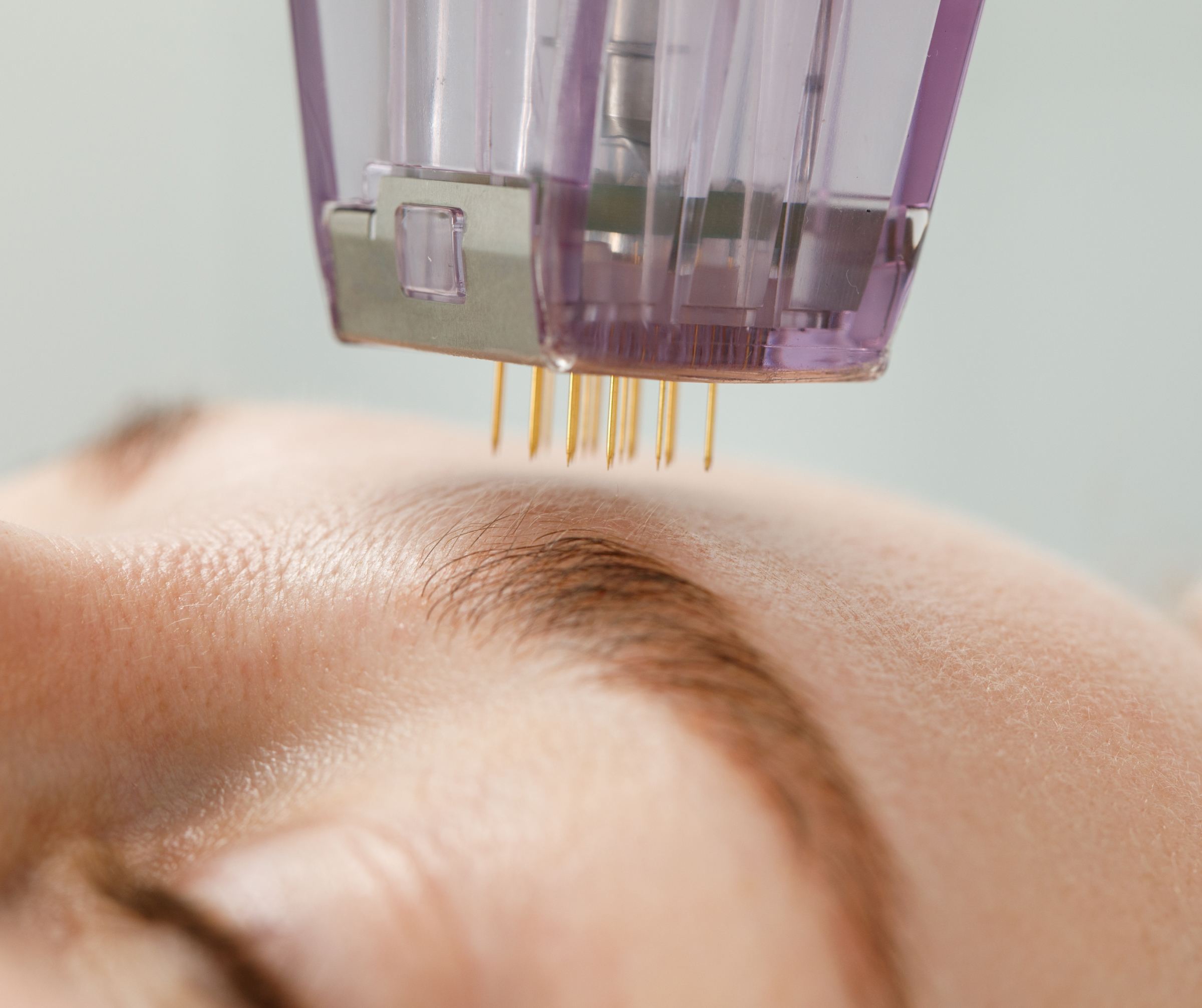 Microneedling