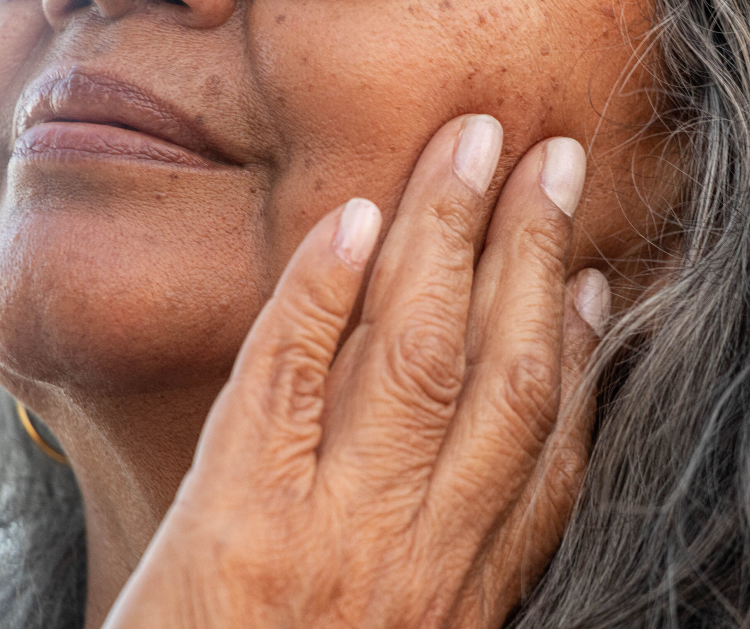 Tâches brunes comment retrouver teint uniforme | Dr Corinne Pachet | Paris